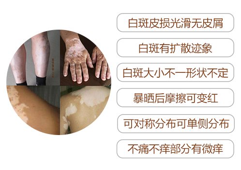 女性白癜风的特点