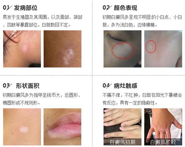 不治疗白斑你能承受住危害吗