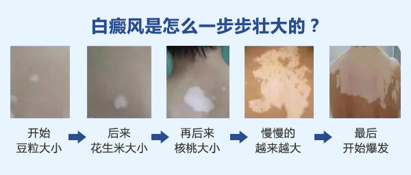 巩固治疗白癜风是科学的吗