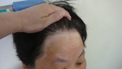 出现什么症状可以判定老年人患上了白癜风