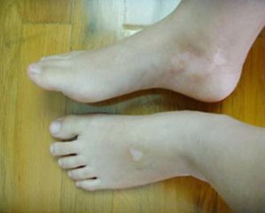 脚部白癜风会不会扩散