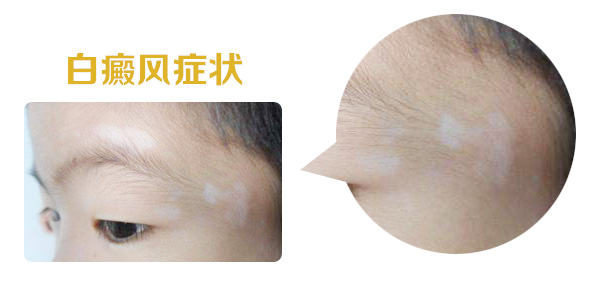 眼部周围出现白斑怎么办