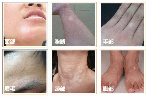 白癜风的症状