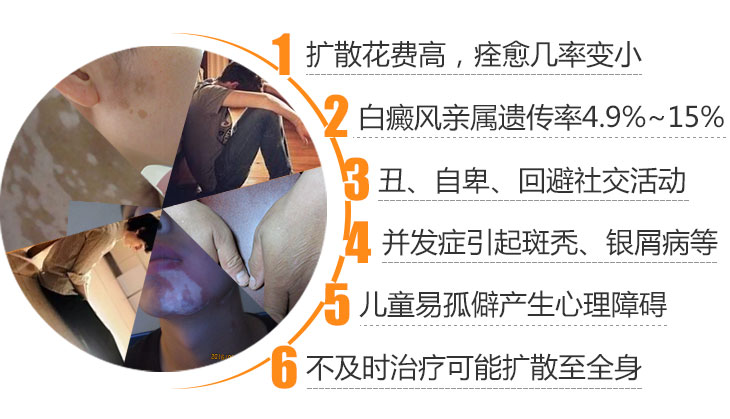 白癜风有哪些危害呢