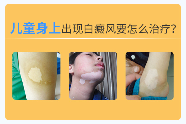丽水白癜风医院讲解儿童得了白癜风怎么办